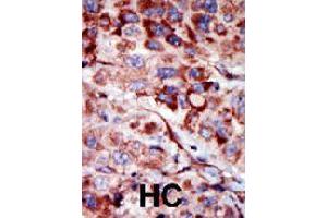 Formalin-fixed and paraffin-embedded human hepatocellular carcinoma tissue reacted with AK2 polyclonal antibody  , which was peroxidase-conjugated to the secondary antibody, followed by AEC staining. (Adenylate Kinase 2 抗体  (C-Term))