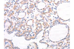 The image on the left is immunohistochemistry of paraffin-embedded Human thyroid cancer tissue using ABIN7131495(TRPC7 Antibody) at dilution 1/25, on the right is treated with fusion protein. (TRPC7 抗体)