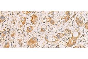 Immunohistochemistry of paraffin-embedded Human liver cancer tissue using RAB38 Polyclonal Antibody at dilution of 1:60(x200) (RAB38 抗体)