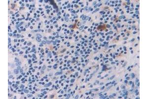 Detection of IL18 in Human Skin cancer Tissue using Polyclonal Antibody to Interleukin 18 (IL18) (IL-18 抗体  (AA 37-193))
