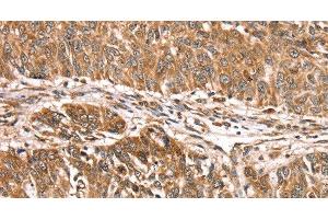 Immunohistochemistry of paraffin-embedded Human lung cancer using PDLIM4 Polyclonal Antibody at dilution of 1:30 (PDLIM4 抗体)
