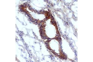 Immunohistochemistry staining (frozen sections) of human tumoral colon epithelium with anti-nitrotyrosine antibody (EM-30). (Nitrotyrosine 抗体)