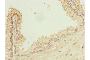 Immunohistochemistry of paraffin-embedded human prostate cancer using ABIN7163733 at dilution of 1:100 (POGZ 抗体  (AA 1-300))