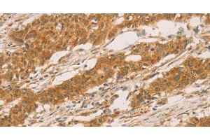 Immunohistochemistry of paraffin-embedded Human gastric cancer tissue using SLC6A3 Polyclonal Antibody at dilution 1:50 (SLC6A3 抗体)