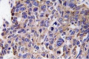 Immunohistochemistry (IHC) analyzes of MMP-12 antibody in paraffin-embedded human lung carcinoma tissue. (MMP12 抗体)