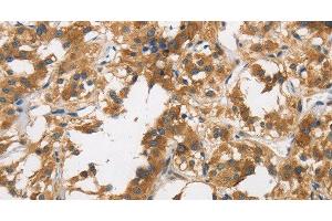 Immunohistochemistry of paraffin-embedded Human thyroid cancer tissue using DUSP23 Polyclonal Antibody at dilution 1:30 (DUSP23 抗体)
