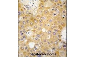 Formalin-fixed and paraffin-embedded human hepatocarcinoma tissue reacted with H1 antibody (N-term) 6302a , which was peroxidase-conjugated to the secondary antibody, followed by DAB staining. (APH1A 抗体  (N-Term))