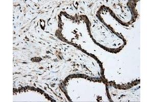 Immunohistochemical staining of paraffin-embedded Carcinoma of prostate tissue using anti-PRKAR2A mouse monoclonal antibody. (PRKAR2A 抗体)