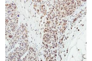IHC-P Image Immunohistochemical analysis of paraffin-embedded SW480 xenograft, using MPP3, antibody at 1:500 dilution.