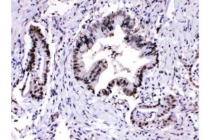 PSMA3 was detected in paraffin-embedded sections of human intetsinal cancer tissues using rabbit anti- PSMA3 Antigen Affinity purified polyclonal antibody (Catalog # ) at 1 ? (PSMA3 抗体  (Middle Region))