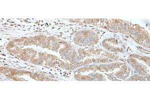 Immunohistochemistry of paraffin-embedded Human liver cancer tissue using USO1 Polyclonal Antibody at dilution of 1:30(x200) (USO1 抗体)