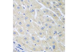Immunohistochemistry of paraffin-embedded human liver cancer using PON1 antibody (ABIN5975112) at dilution of 1/100 (40x lens). (PON1 抗体)