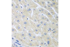 Immunohistochemistry of paraffin-embedded human liver cancer using PON1 antibody (ABIN5975112) at dilution of 1/100 (40x lens). (PON1 抗体)