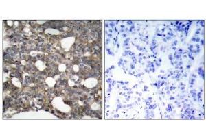 Immunohistochemical analysis of paraffin-embedded human breast carcinoma tissue, using Connexin43 (Ab-367) antibody (E021250). (Connexin 43/GJA1 抗体)