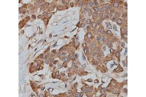 ABIN6265118 and ABIN6279217 at 1/200 staining human lymphoma tissue sections by IHC-P. (slc25a13 抗体  (C-Term))