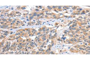 Immunohistochemistry of paraffin-embedded Human esophagus cancer tissue using CGB Polyclonal Antibody at dilution 1:60 (CGB 抗体)