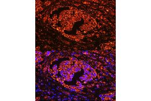 Immunofluorescence analysis of human lung cancer using  Rabbit pAb (ABIN3016195, ABIN3016196, ABIN3016197, ABIN1678542 and ABIN6219616) at dilution of 1:100 (40x lens). (ACP5 抗体  (AA 76-325))