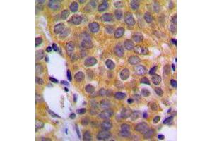 Immunohistochemical analysis of DUSP1 staining in human prostate cancer formalin fixed paraffin embedded tissue section. (DUSP1 抗体  (C-Term))