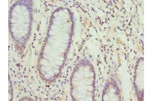 Immunohistochemistry of paraffin-embedded human colon cancer using ABIN7149015 at dilution of 1:100 (NFS1 抗体  (AA 208-457))