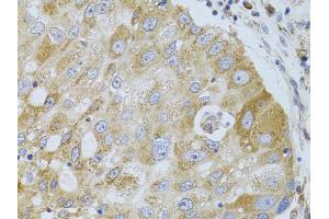 Immunohistochemistry of paraffin-embedded human breast cancer using HDAC8 antibody (ABIN5973443) at dilution of 1/100 (40x lens). (HDAC8 抗体)