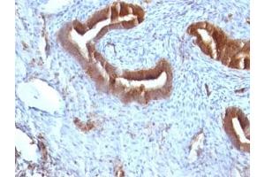 Formalin-fixed, paraffin-embedded human endometrial carcinoma stained with Beta-2-Microglobulin antibody. (beta-2 Microglobulin 抗体)