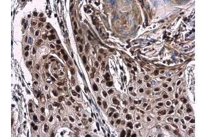 IHC-P Image NuMA antibody [N1], N-term detects NuMA protein at nucleus in human esophageal cancer by immunohistochemical analysis. (NUMA1 抗体  (N-Term))