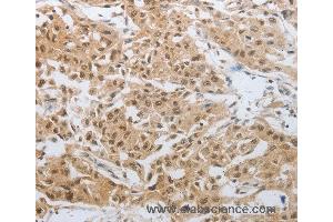 Immunohistochemistry of Human lung cancer using DNAJC7 Polyclonal Antibody at dilution of 1:25 (DNAJC7 抗体)