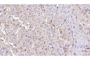ABIN6273312 at 1/100 staining Human thyroid cancer tissue by IHC-P. (RPS14 抗体  (Internal Region))