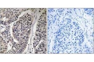 Immunohistochemistry analysis of paraffin-embedded human breast carcinoma, using p130 Cas (Phospho-Tyr410) Antibody. (BCAR1 抗体  (pTyr410))