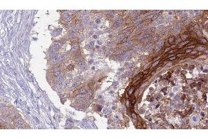 ABIN6277039 at 1/100 staining Human urothelial cancer tissue by IHC-P. (SLAMF1 抗体  (C-Term))
