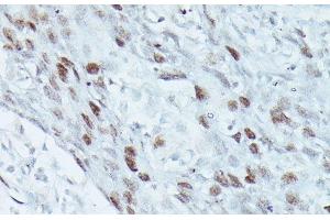 Immunohistochemistry of paraffin-embedded Human breast cancer using MEF2C Polyclonal Antibody at dilution of 1:100 (40x lens). (MEF2C 抗体)
