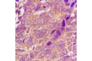Immunohistochemical analysis of CDC25A staining in human breast cancer formalin fixed paraffin embedded tissue section. (CDC25A 抗体  (N-Term))