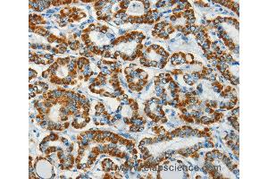 Immunohistochemistry of Human thyroid cancer using BCAT2 Polyclonal Antibody at dilution of 1:70 (BCAT2 抗体)