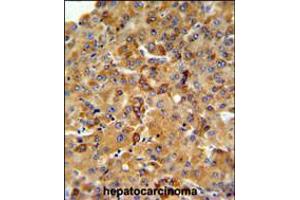SFT2D3 Antibody IHC analysis in formalin fixed and paraffin embedded human hepatocarcinoma followed by peroxidase conjugation of the secondary antibody and DAB staining.