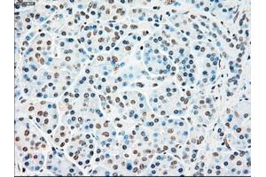 Immunohistochemical staining of paraffin-embedded Adenocarcinoma of colon tissue using anti-STK3mouse monoclonal antibody. (STK3 抗体)