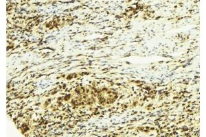 ABIN6278766 at 1/100 staining Human breast cancer tissue by IHC-P. (ZFPM2 抗体  (C-Term))