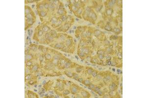 Immunohistochemistry of paraffin-embedded human liver cancer using MAOA antibody. (Monoamine Oxidase A 抗体  (AA 1-260))