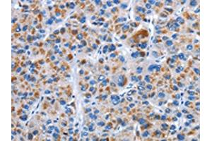 The image on the left is immunohistochemistry of paraffin-embedded Human liver cancer tissue using ABIN7128906(CENPJ Antibody) at dilution 1/40, on the right is treated with fusion protein. (CENPJ 抗体)