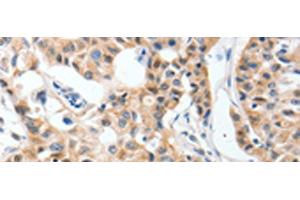 Immunohistochemistry of paraffin-embedded Human lung cancer tissue using P2RY6 Polyclonal Antibody at dilution of 1:40(x200) (P2RY6 抗体)