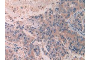 DAB staining on IHC-P; Samples: Human Breast cancer Tissue (SCUBE3 抗体  (AA 807-993))