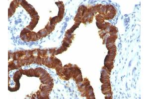 Formalin-fixed, paraffin-embedded human Ovarian Carcinoma stained with Cytokeratin 7 Mouse Monoclonal Antibody (KRT7/1198). (Cytokeratin 7 抗体)