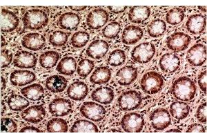Immunohistochemistry of paraffin-embedded Human colon carcinoma tissue using gamma Tubulin Monoclonal Antibody at dilution of 1:200. (TUBG1 抗体)