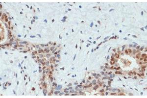 Immunohistochemistry of paraffin-embedded Human breast cancer using Phospho-AKT(S473) Polyclonal Antibody at dilution of 1:200 (40x lens). (AKT1 抗体  (pSer473))