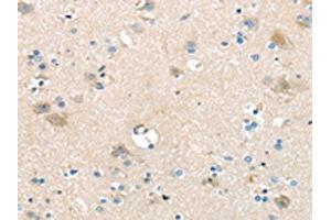 The image on the left is immunohistochemistry of paraffin-embedded Human brain tissue using ABIN7192395(SLC16A11 Antibody) at dilution 1/25, on the right is treated with synthetic peptide.
