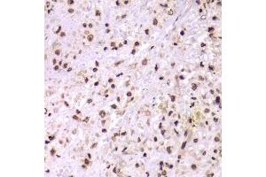 Immunohistochemistry of paraffin-embedded human adenomyosis using XRCC6 Antibody.
