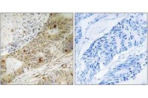 Immunohistochemistry analysis of paraffin-embedded human colon carcinoma, using ATRIP (Phospho-Ser224) Antibody.