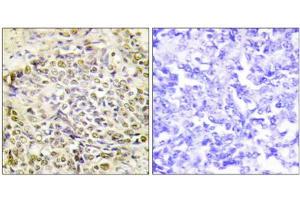 Immunohistochemistry analysis of paraffin-embedded human lung carcinoma tissue using IRX2 antibody. (IRX2 抗体  (Internal Region))