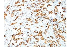 Formalin-fixed, paraffin-embedded human Breast Carcinoma stained with HSP27 Monoclonal Antibody (SPM252) (HSP27 抗体)
