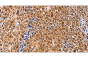 Immunohistochemistry of paraffin-embedded Human ovarian cancer using MKP-2 Polyclonal Antibody at dilution of 1:30 (DUSP4 抗体)