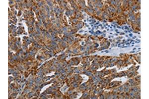 The image on the left is immunohistochemistry of paraffin-embedded Human ovarian cancer tissue using ABIN7192612(SPAG1 Antibody) at dilution 1/25, on the right is treated with synthetic peptide. (SPAG1 抗体)